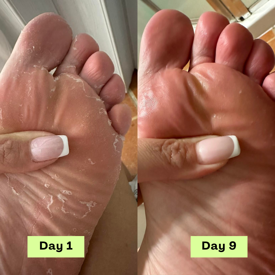 Luvira's Loravey® AntiFungal Relief Soap Bar