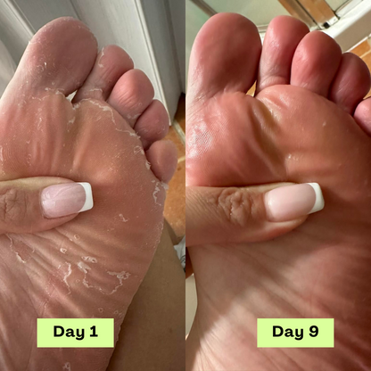 Luvira's Loravey® AntiFungal Relief Soap Bar